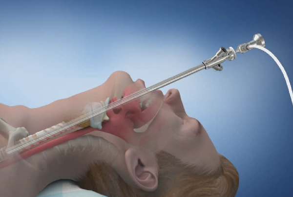 Bronchoscopy