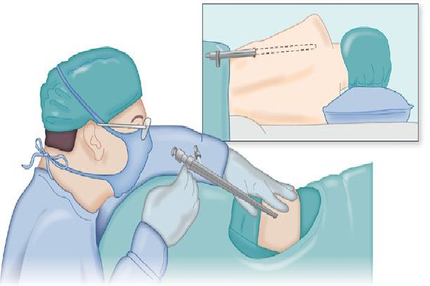 Thoracoscopy