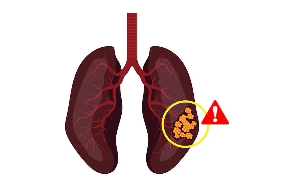Specialised Lung Cancer